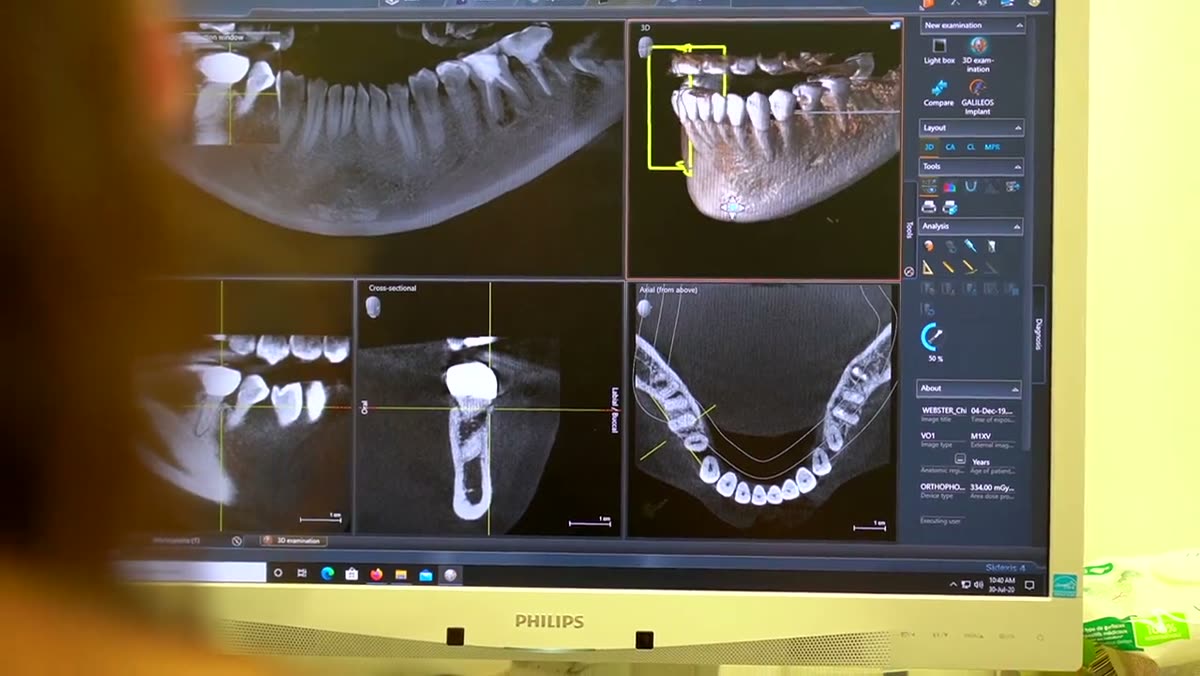 A panoramic dental X-ray on a monitor with one tooth highlighted.