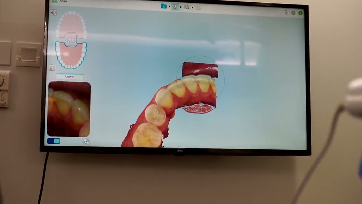 A live 3D intraoral scan building up on a wall-mounted screen.
