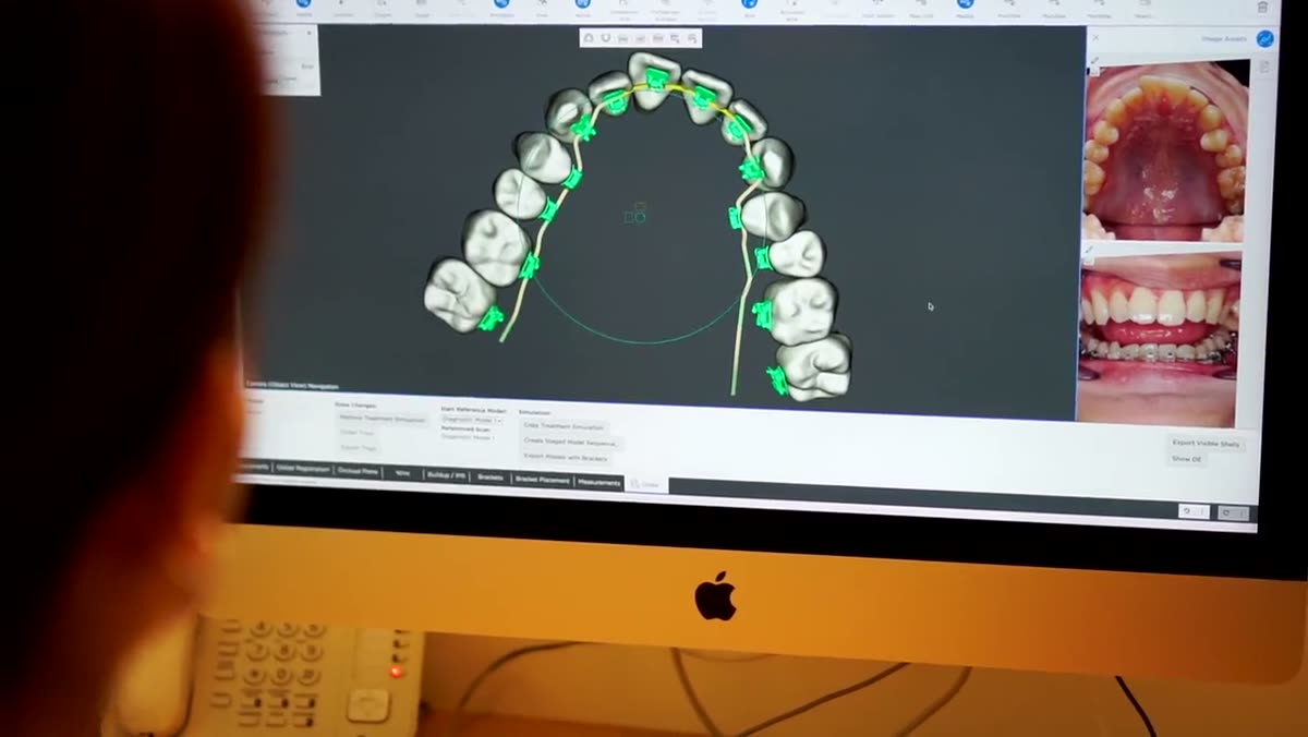 A clinician at a monitor reviewing a marked-up 3D dental arch.